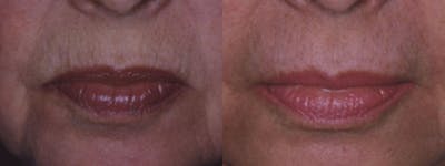 Microneedling Before & After Gallery - Patient 216491 - Image 1