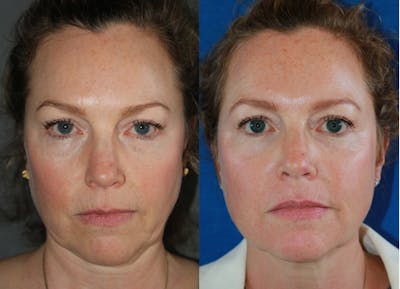 Microneedling Before & After Gallery - Patient 586663 - Image 1