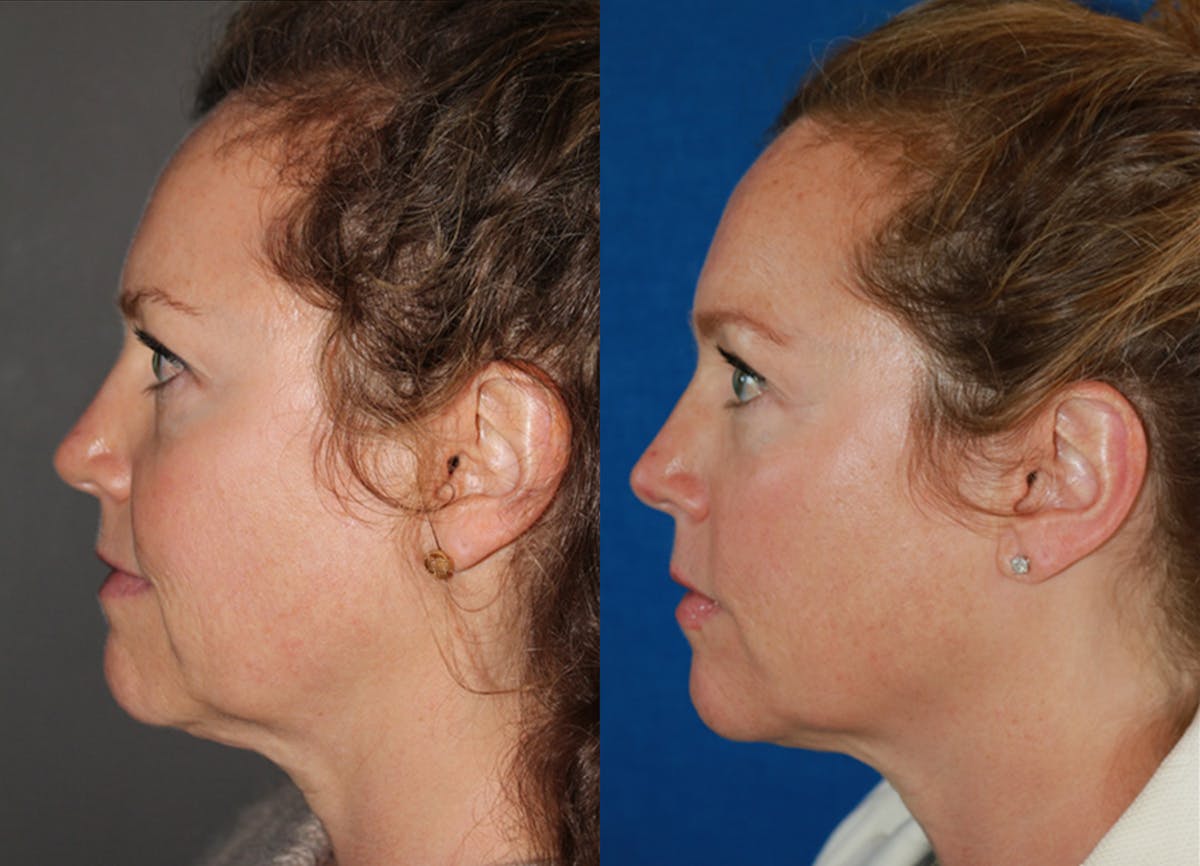 Microneedling Before & After Gallery - Patient 586663 - Image 2