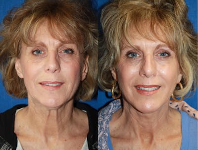 Facelift Before & After Gallery - Patient 276730 - Image 1