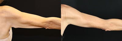 Arm Lift (Brachioplasty) Before & After Gallery - Patient 250473 - Image 1