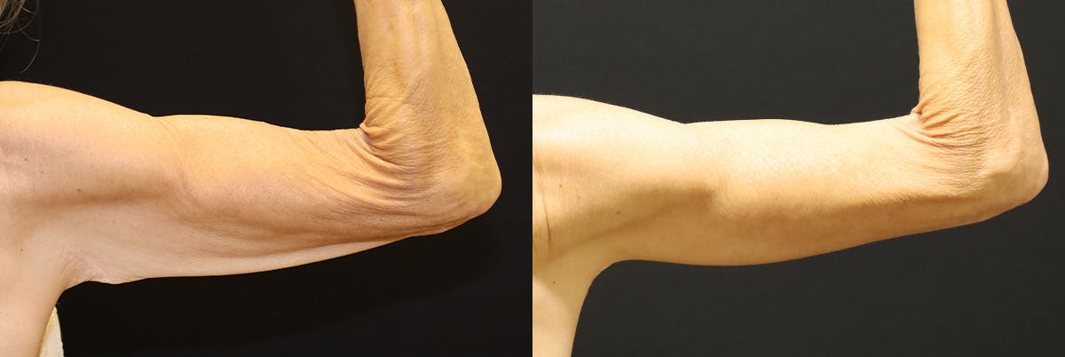 Arm Lift (Brachioplasty) Before & After Gallery - Patient 250473 - Image 2