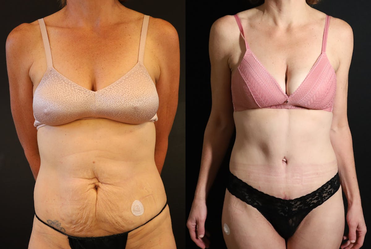 Liposuction Before & After Gallery - Patient 640600 - Image 1