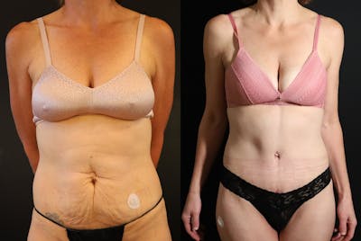 Liposuction Before & After Gallery - Patient 640600 - Image 1