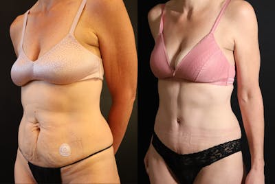Liposuction and Fat Transfer Before & After Gallery - Patient 640600 - Image 2