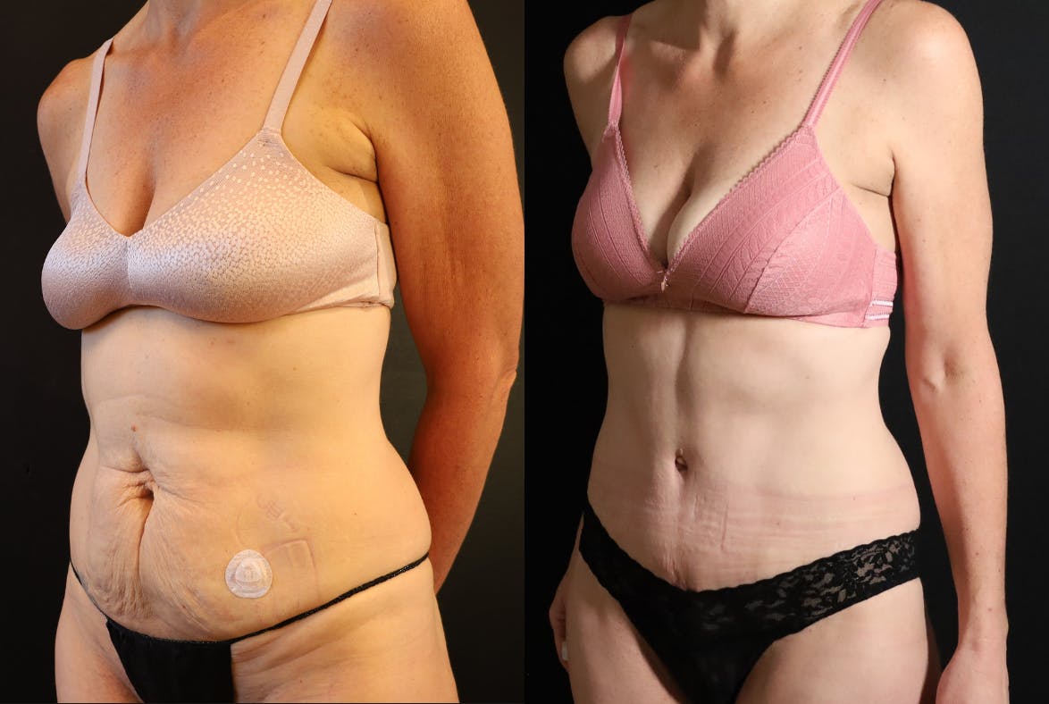 Abdominoplasty (Tummy Tuck) Before & After Gallery - Patient 257538 - Image 2