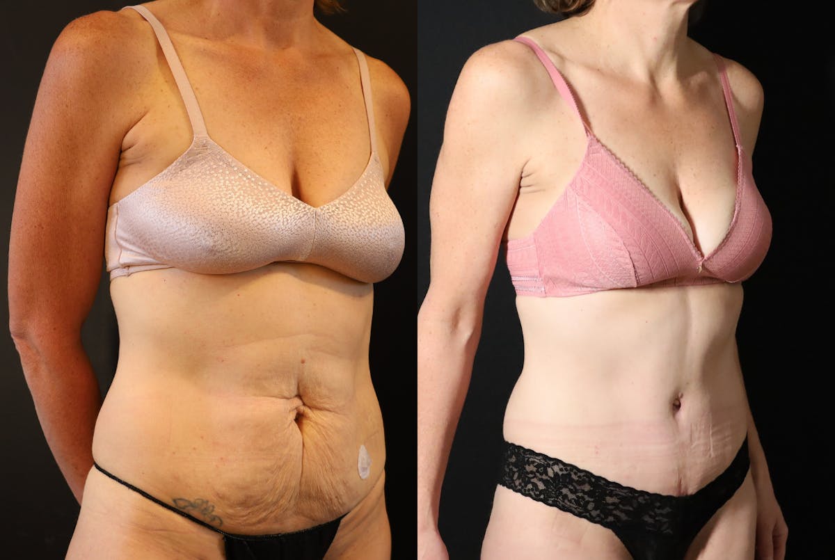 Liposuction Before & After Gallery - Patient 640600 - Image 3