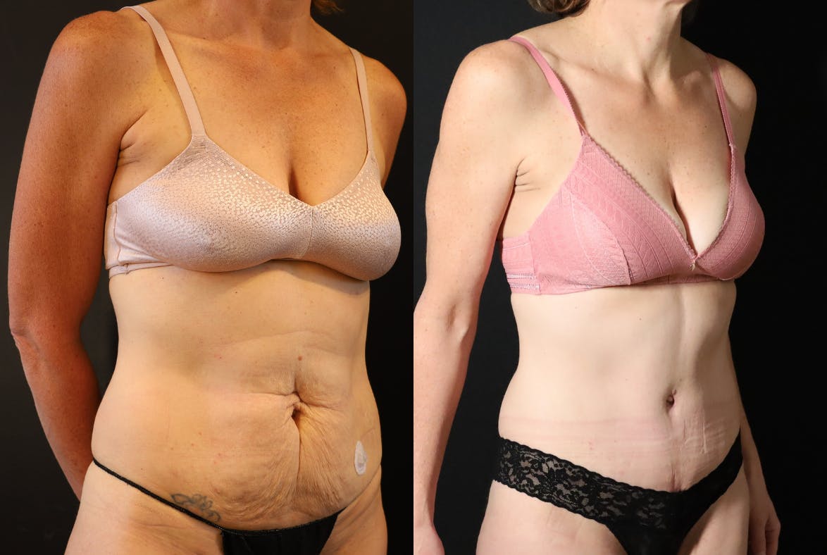 Abdominoplasty (Tummy Tuck) Before & After Gallery - Patient 257538 - Image 3