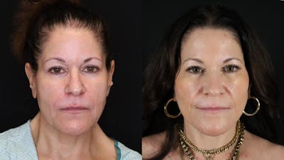 Deep Plane Facelift Before & After Gallery - Patient 297879 - Image 1