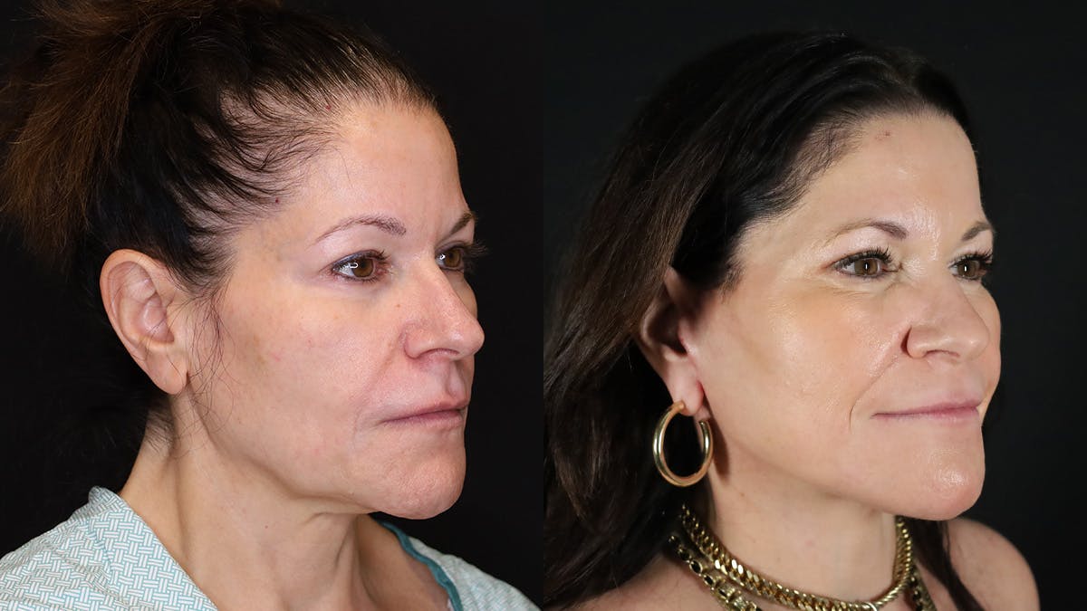 CO2 Laser Resurfacing Before & After Gallery - Patient 947022 - Image 2