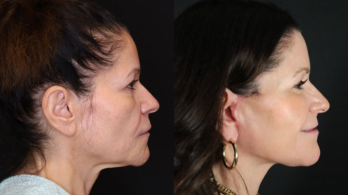 CO2 Laser Resurfacing Before & After Gallery - Patient 947022 - Image 3