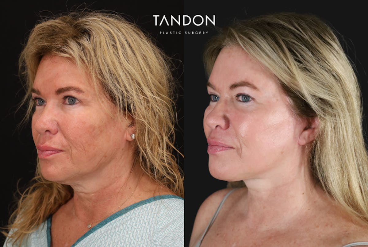 CO2 Laser Resurfacing Before & After Gallery - Patient 116287 - Image 2