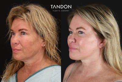 Deep Plane Facelift Before & After Gallery - Patient 154863 - Image 1