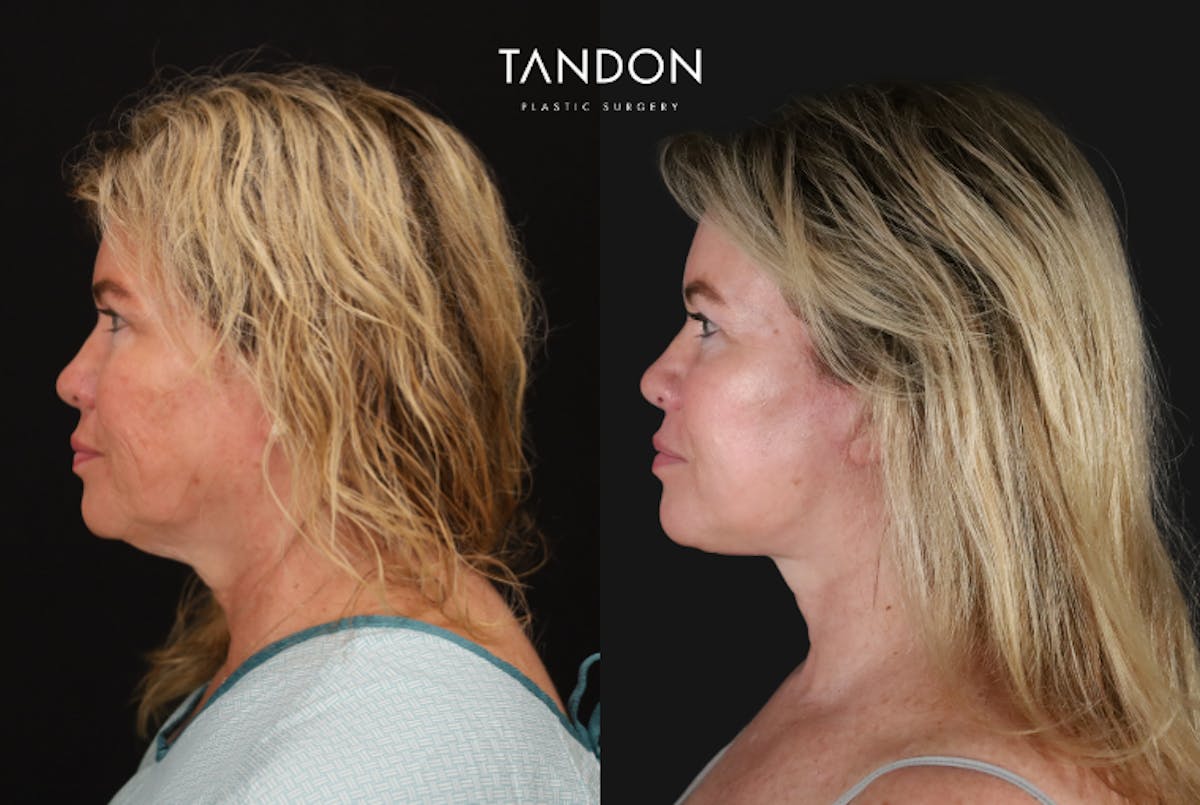 CO2 Laser Resurfacing Before & After Gallery - Patient 116287 - Image 3