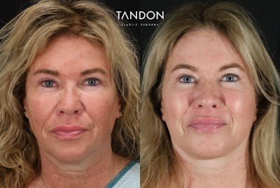 Deep Plane Facelift Before & After Gallery - Patient 154863 - Image 1