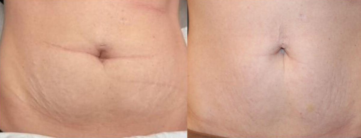 CO2 Laser Resurfacing Before & After Gallery - Patient 141667 - Image 1