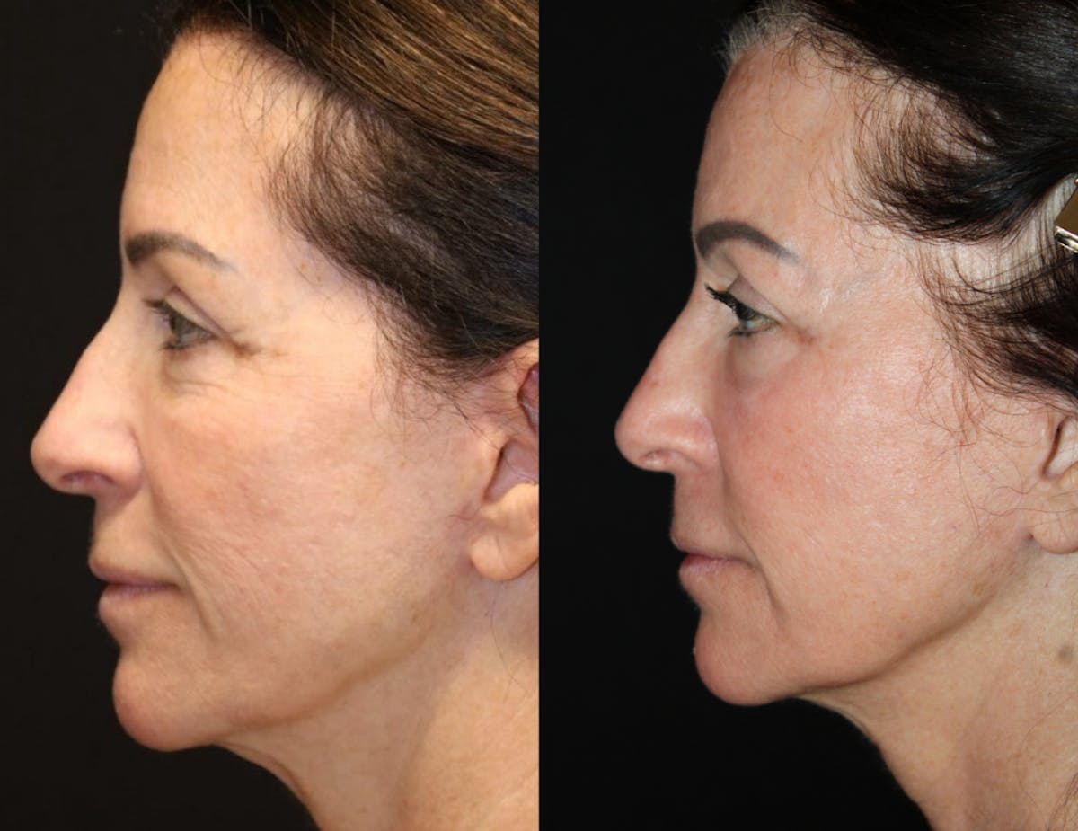 CO2 Laser Resurfacing Before & After Gallery - Patient 322839 - Image 1