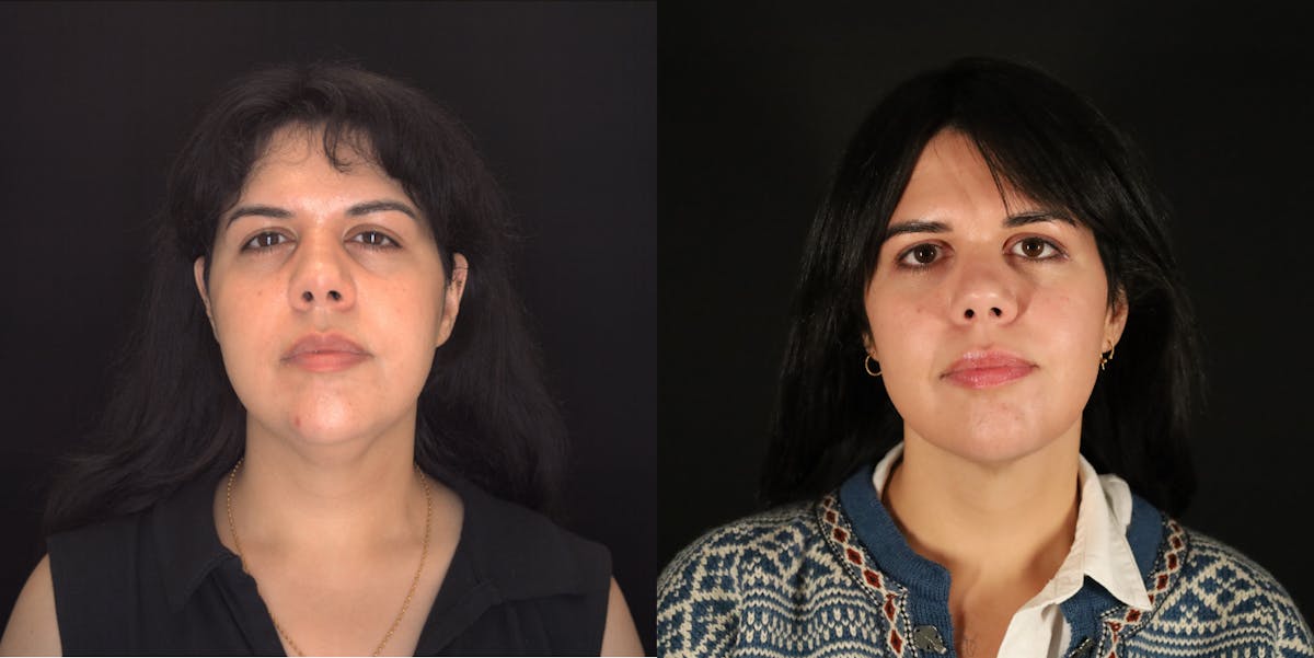 Neck Liposuction Before & After Gallery - Patient 187259 - Image 3