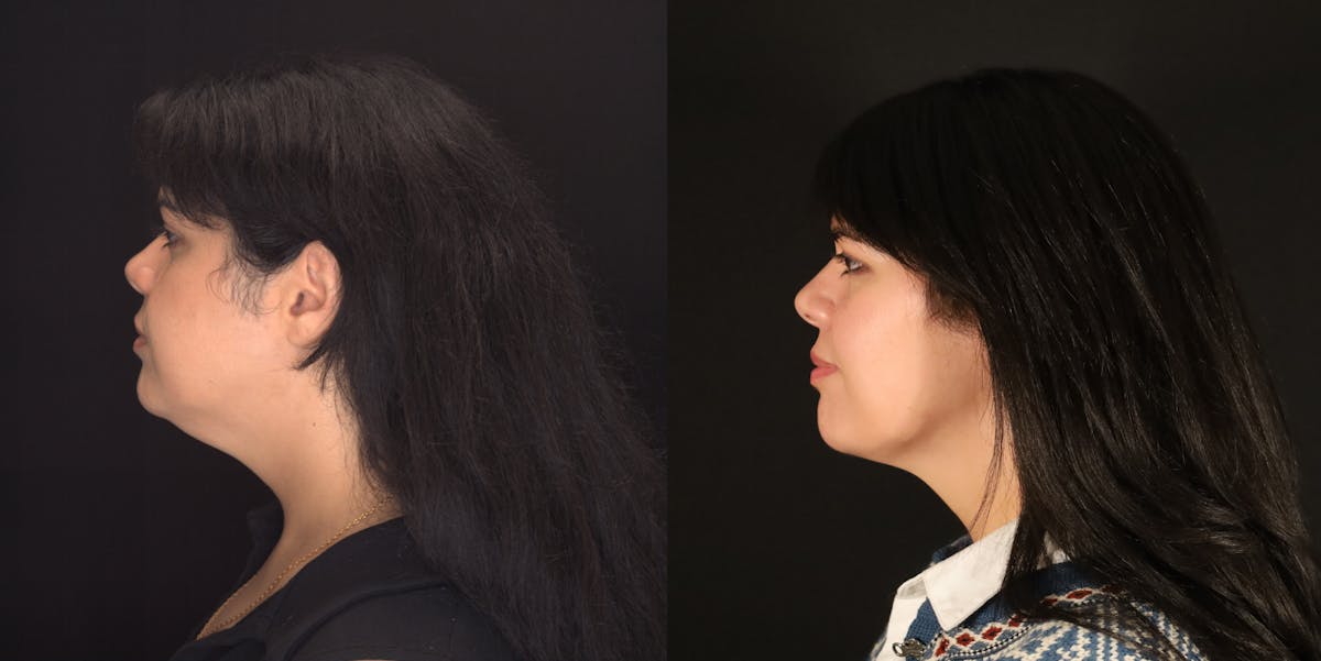 Neck Liposuction Before & After Gallery - Patient 187259 - Image 5