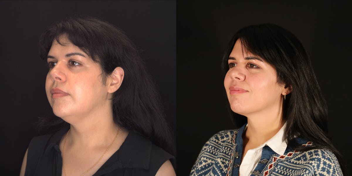 Neck Liposuction Before & After Gallery - Patient 187259 - Image 4