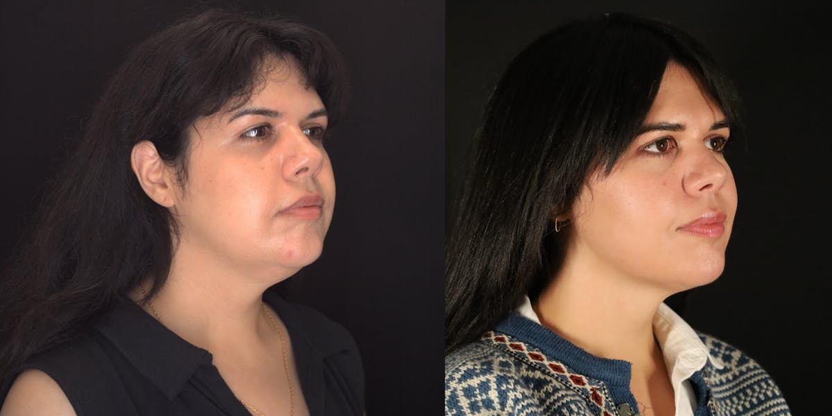 Neck Liposuction Before & After Gallery - Patient 187259 - Image 2