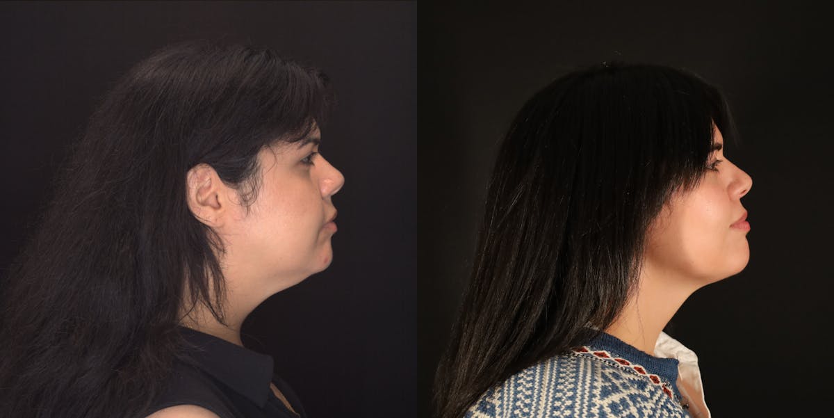 Neck Liposuction Before & After Gallery - Patient 187259 - Image 1