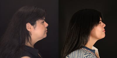 Neck Liposuction Before & After Gallery - Patient 187259 - Image 1