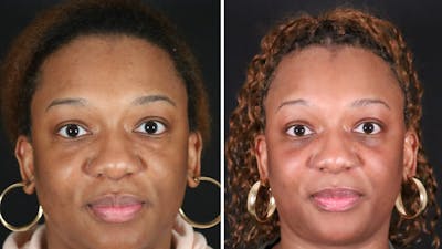 Blepharoplasty Before & After Gallery - Patient 318347 - Image 1