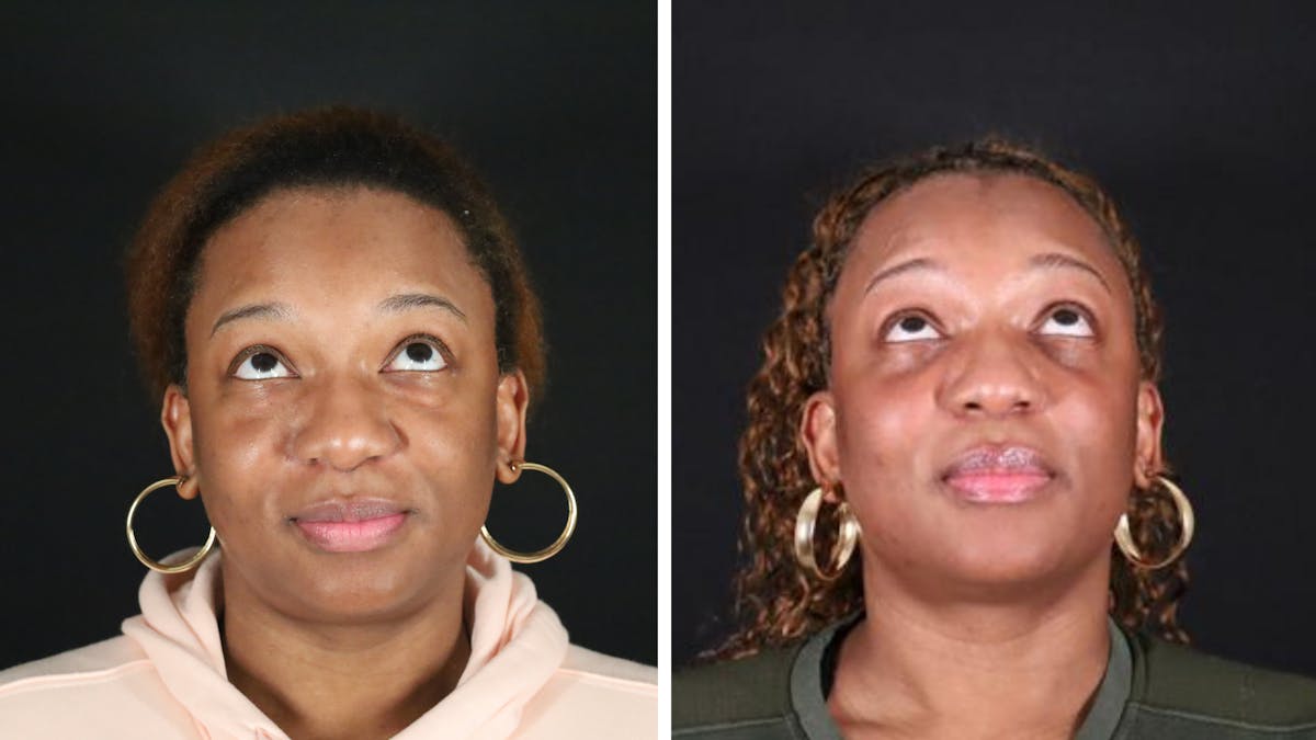 Blepharoplasty Before & After Gallery - Patient 318347 - Image 2