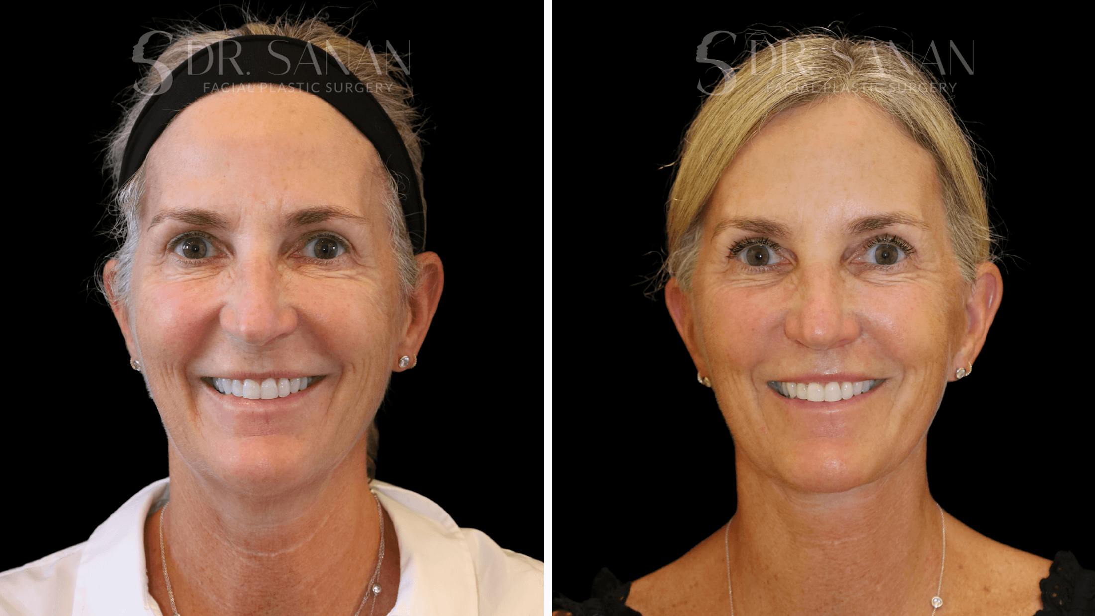 Neck Lift Before & After Gallery - Patient 121901 - Image 9