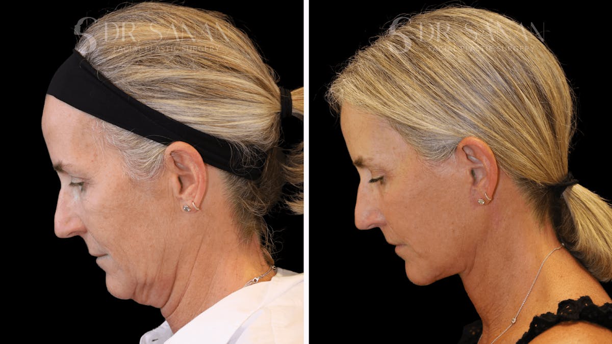 Neck Lift Before & After Gallery - Patient 121901 - Image 4