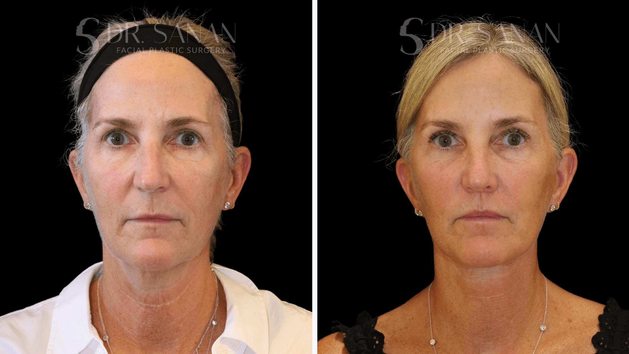 Neck Lift Before & After Gallery - Patient 121901 - Image 10