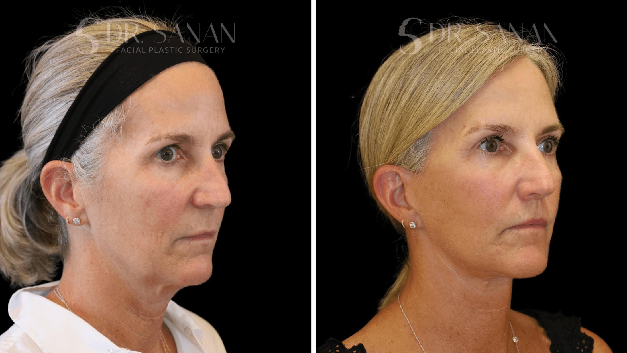 Neck Lift Before & After Gallery - Patient 121901 - Image 5