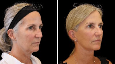 Deep Plane Facelift Before & After Gallery - Patient 335328 - Image 1