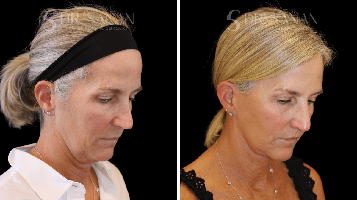 Neck Lift Before & After Gallery - Patient 121901 - Image 6