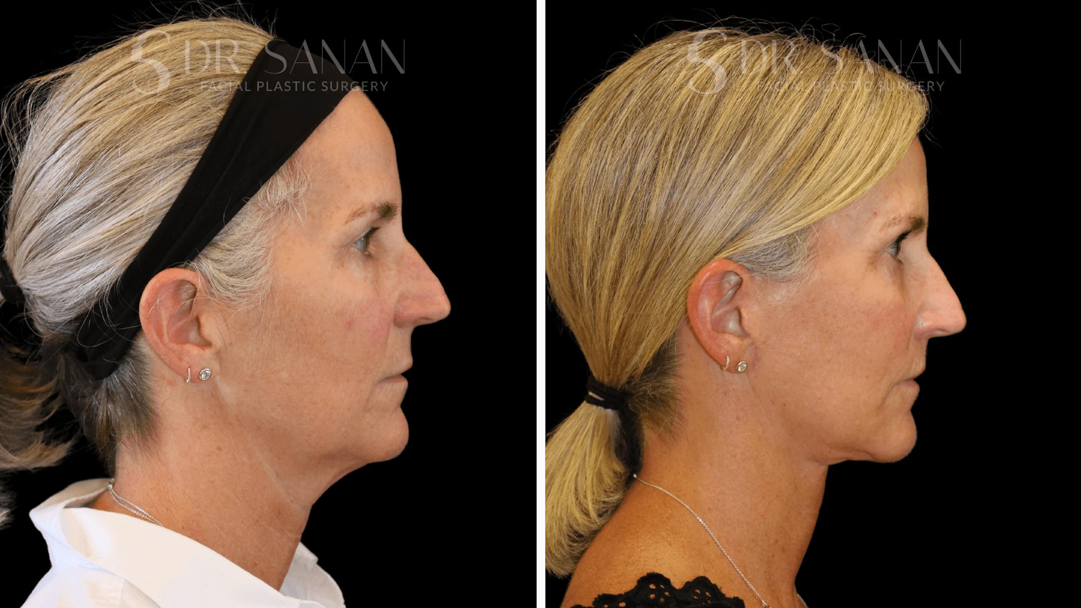 Neck Lift Before & After Gallery - Patient 121901 - Image 2