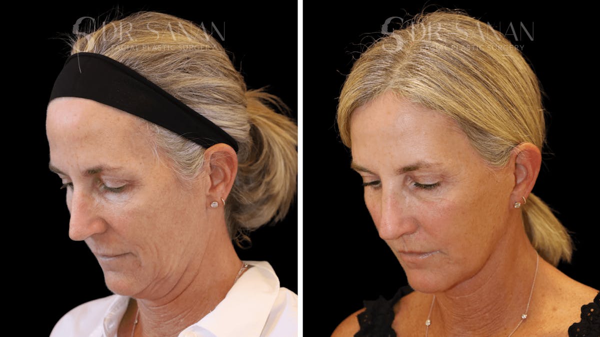 Neck Lift Before & After Gallery - Patient 121901 - Image 7