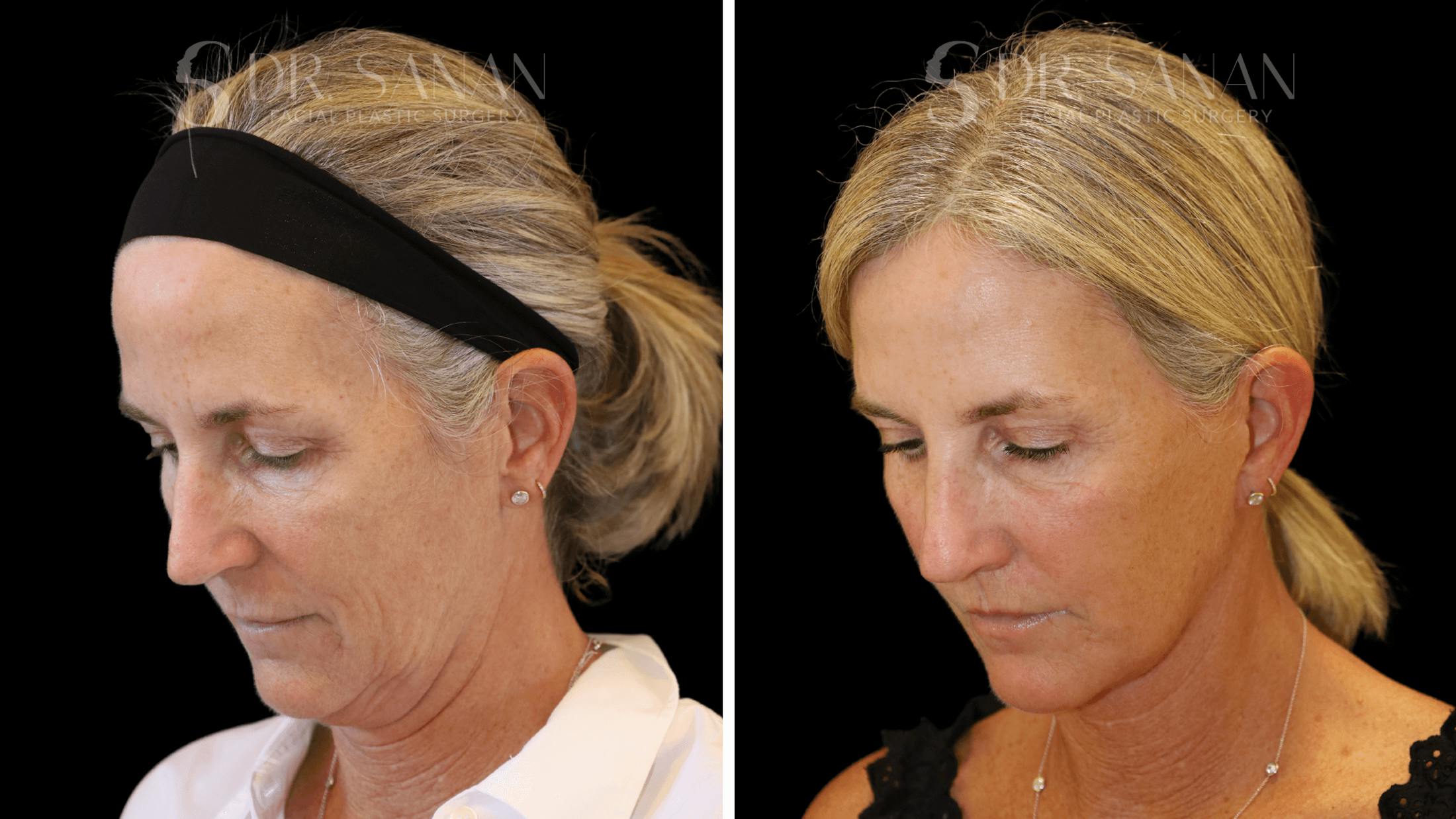Neck Lift Before & After Gallery - Patient 121901 - Image 7