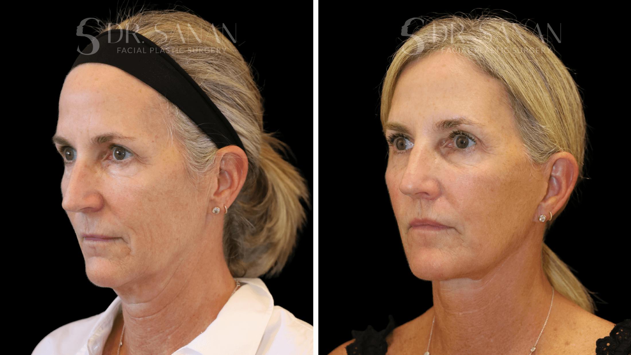 Neck Lift Before & After Gallery - Patient 121901 - Image 8