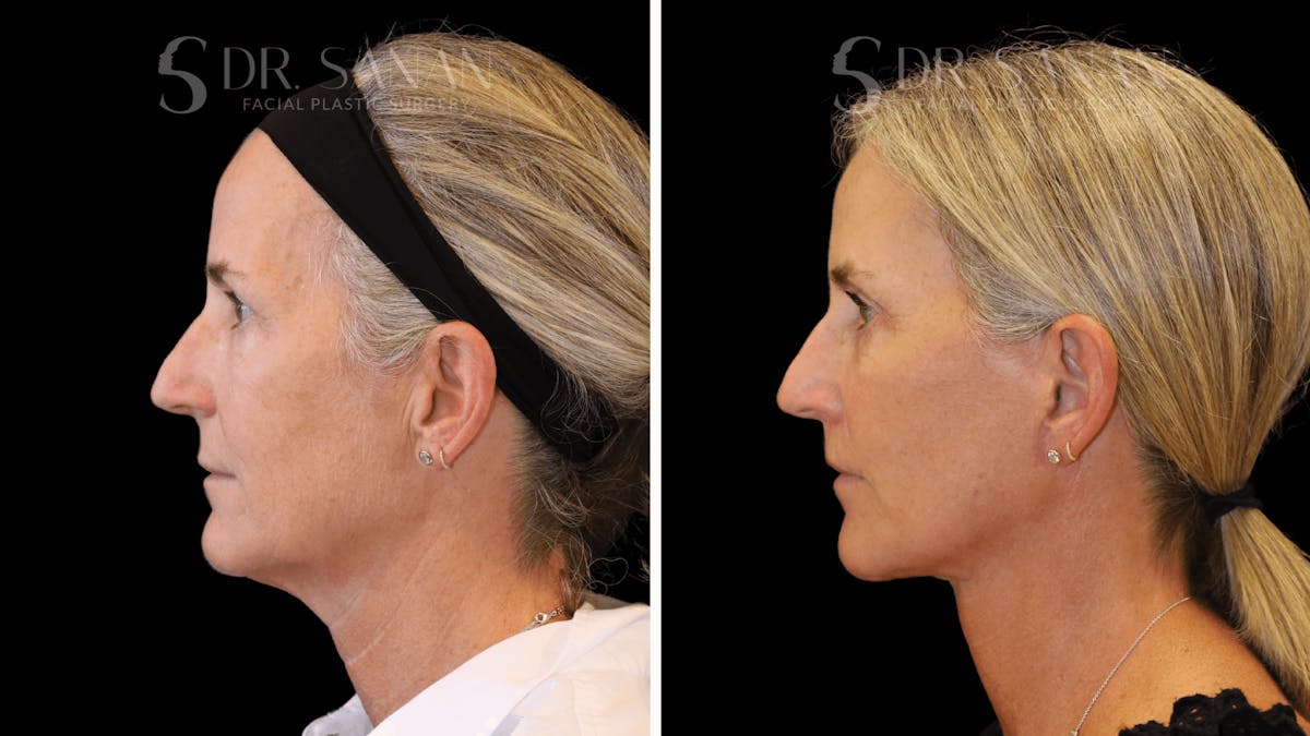 Neck Lift Before & After Gallery - Patient 121901 - Image 1