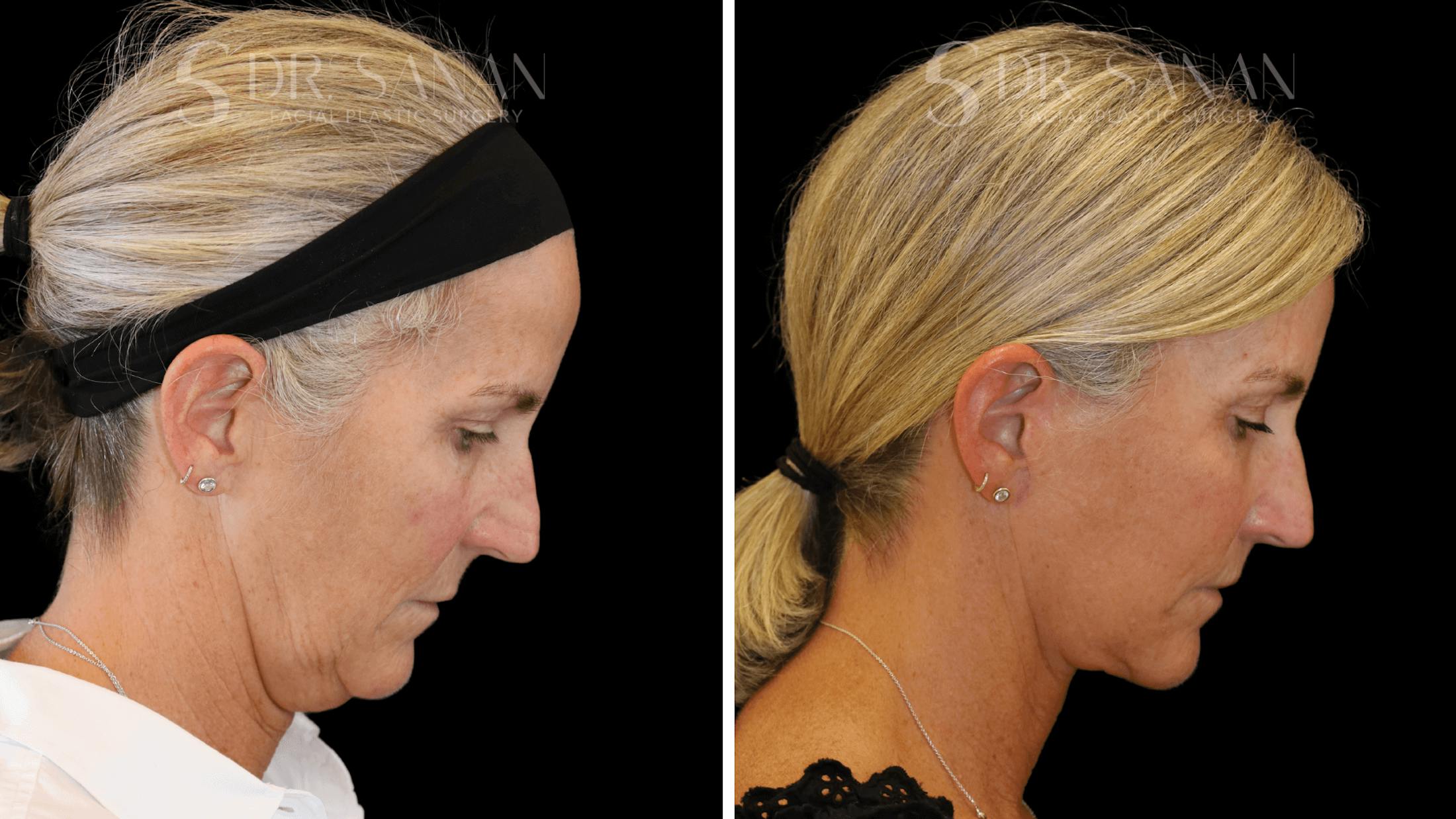 Neck Lift Before & After Gallery - Patient 121901 - Image 3