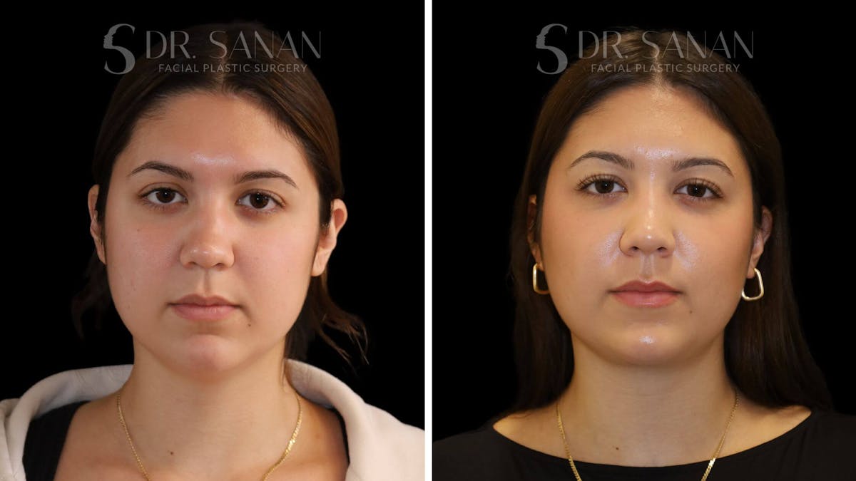 Neck Lift Before & After Gallery - Patient 109948 - Image 6