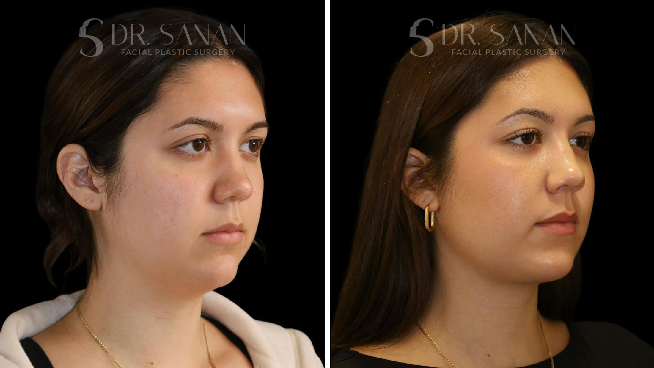 Neck Lift Before & After Gallery - Patient 109948 - Image 4