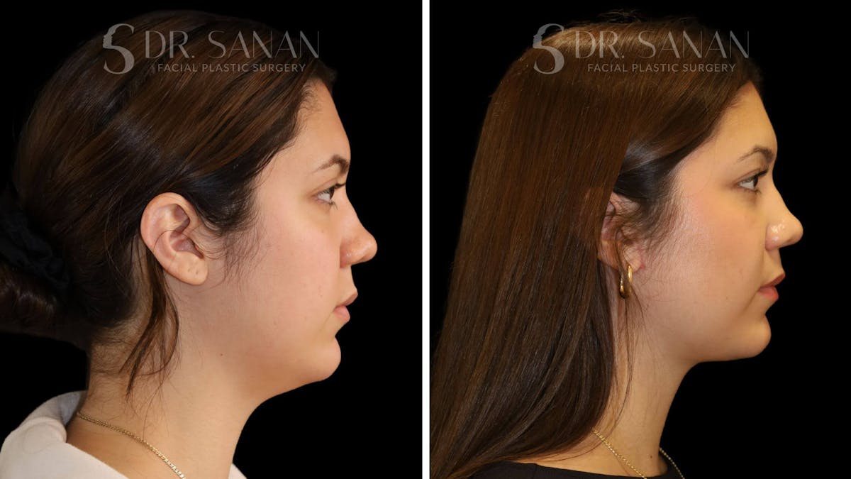 Neck Lift Before & After Gallery - Patient 109948 - Image 2