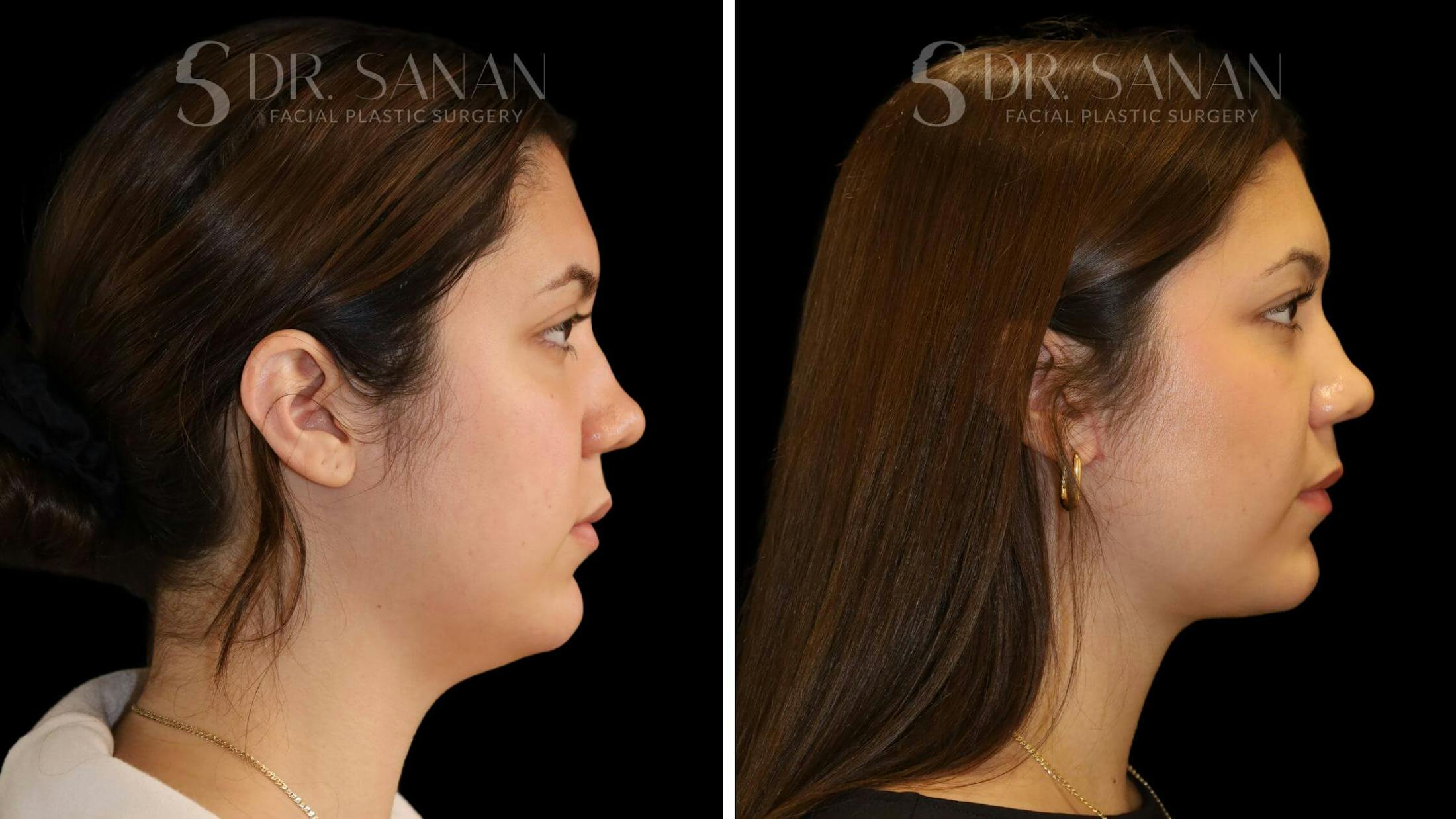 Neck Lift Before & After Gallery - Patient 109948 - Image 2