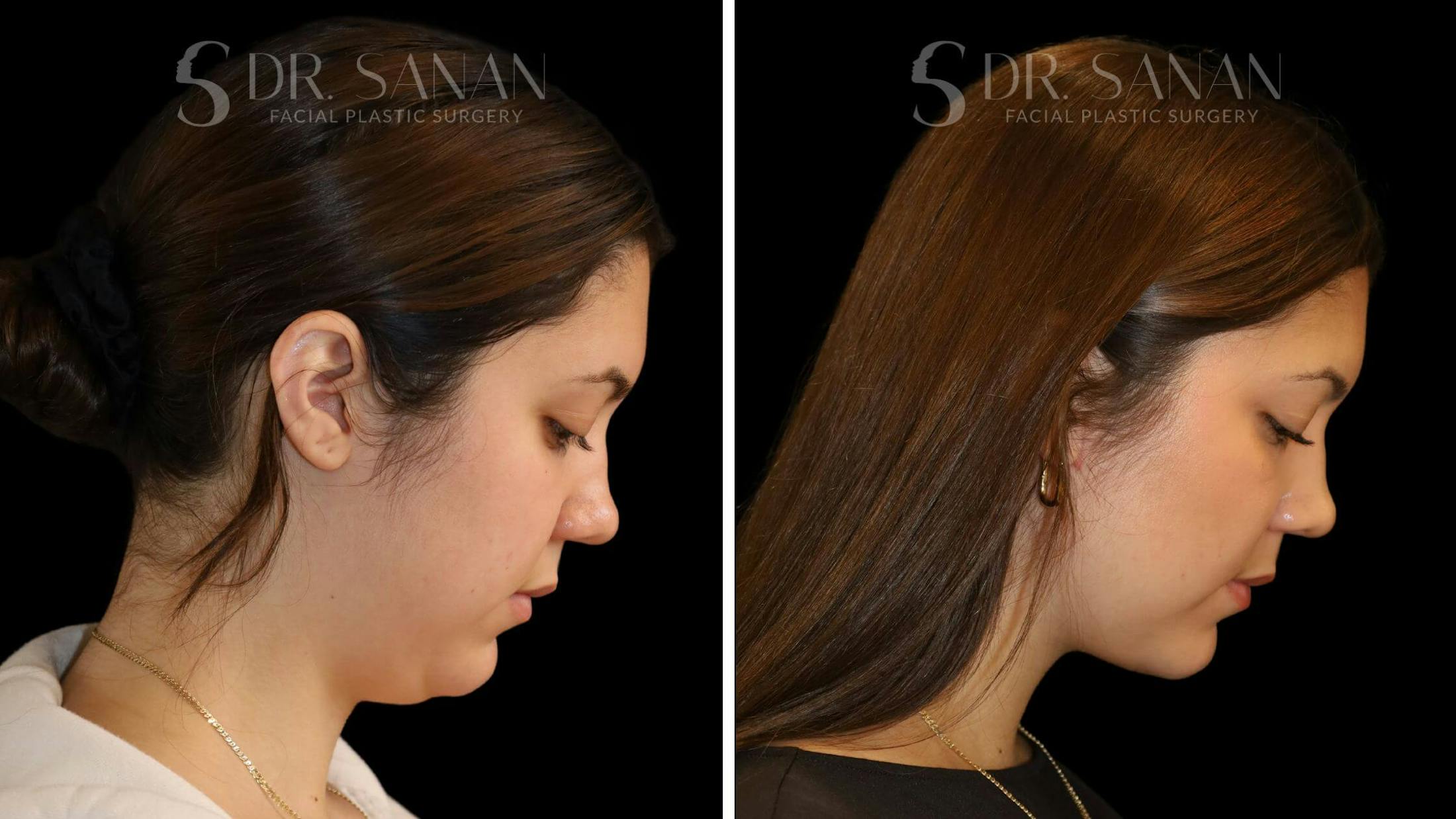 Neck Lift Before & After Gallery - Patient 109948 - Image 7