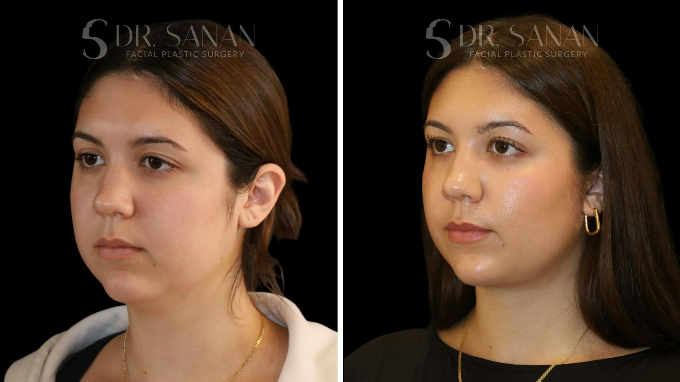 Neck Lift Before & After Gallery - Patient 109948 - Image 3