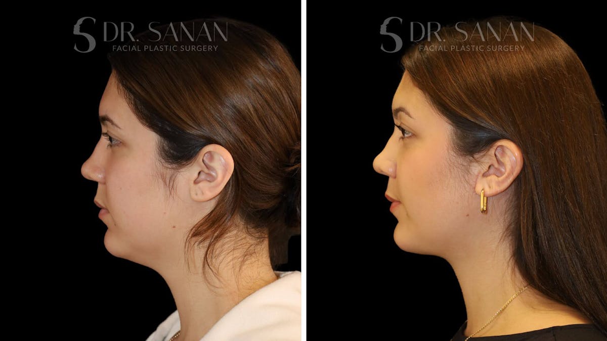 Neck Lift Before & After Gallery - Patient 109948 - Image 1