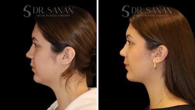 Neck Lift Before & After Gallery - Patient 109948 - Image 1