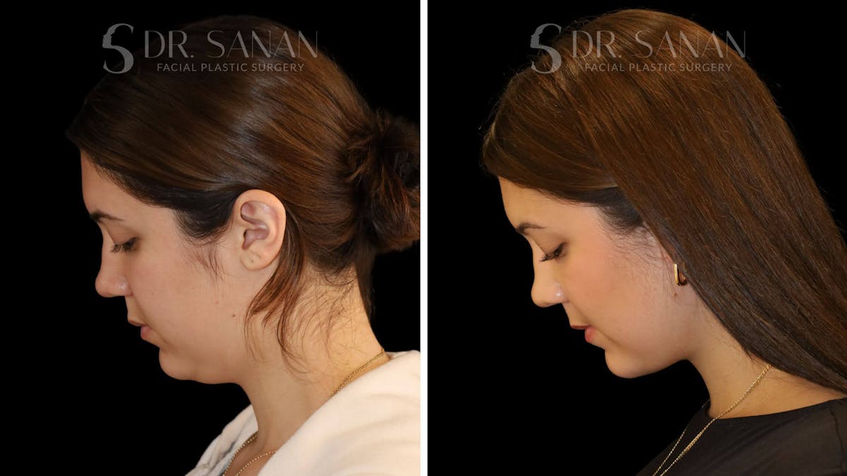 Neck Lift Before & After Gallery - Patient 109948 - Image 5